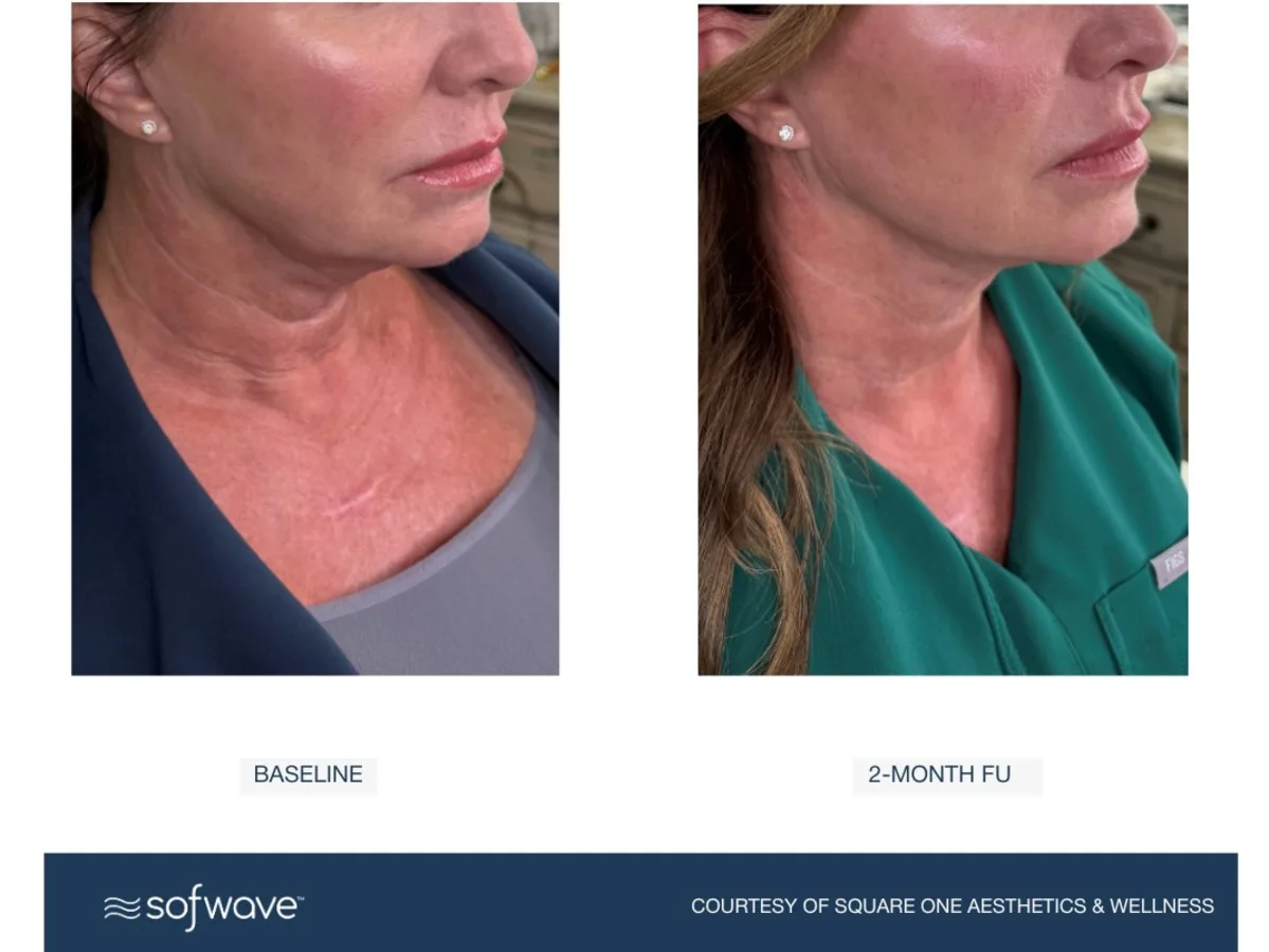 Sofwave™ The Jawline and Neck Package